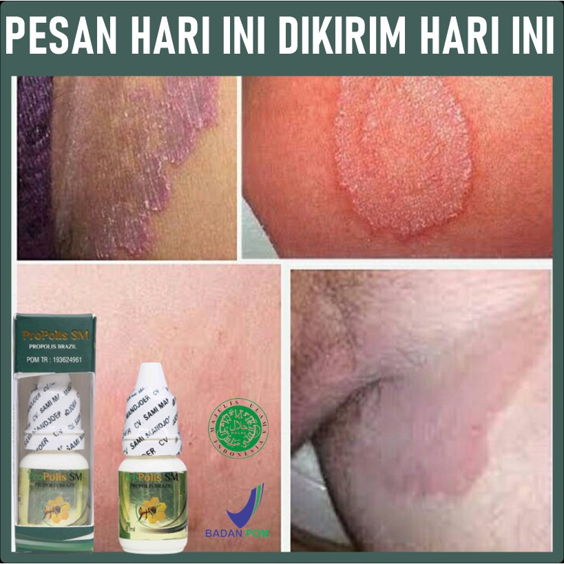 Obat Lecet Selangkangan Homecare24