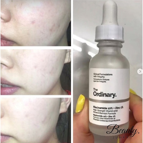Jual The Ordinary Niacinamide 10% + Zinc 1% 30Ml Serum Wajah Untuk Jerawat Safa | Shopee Indonesia