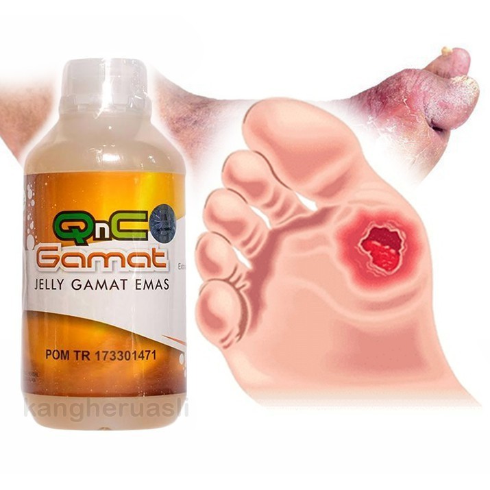 Jual QNC Obat Salep Luka Diabetes Basah yang Bernanah Indonesia|Shopee  Indonesia