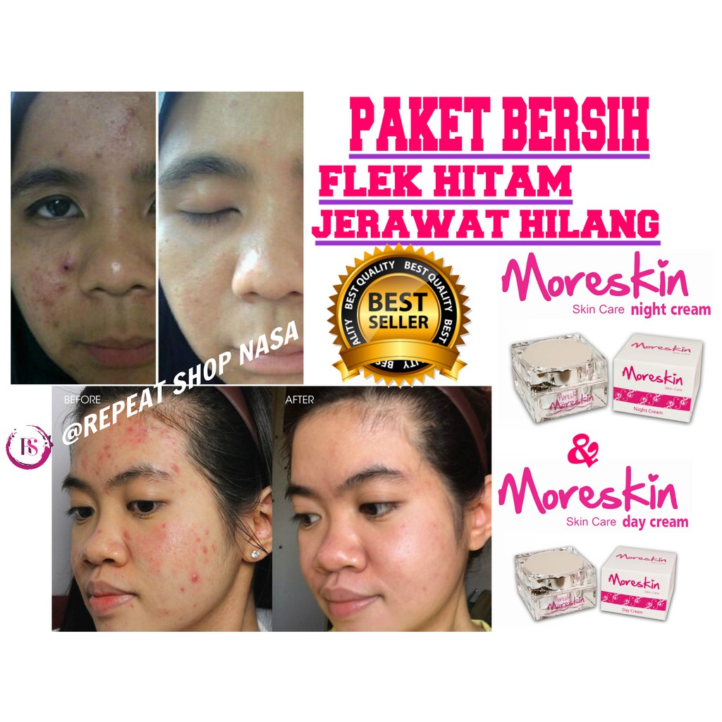 Cara Menghilangkan Noda Hitam Bekas Jerawat Dalam 1 Malam