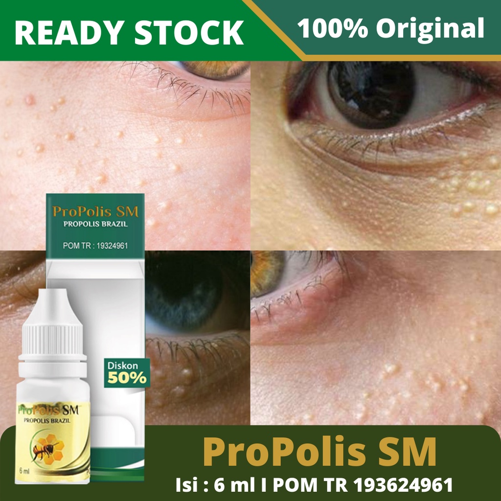 Jual Obat Milia di Mata Paling Terbukti, di Wajah, Di Kelopak Mata, Di  Hidung, Di Pipi, Di Atas / Bawah Mata, Brutusan Bruntusan Kecil, Milia,  Bintik Bintik Putih di Bawah Mata, Jerawat