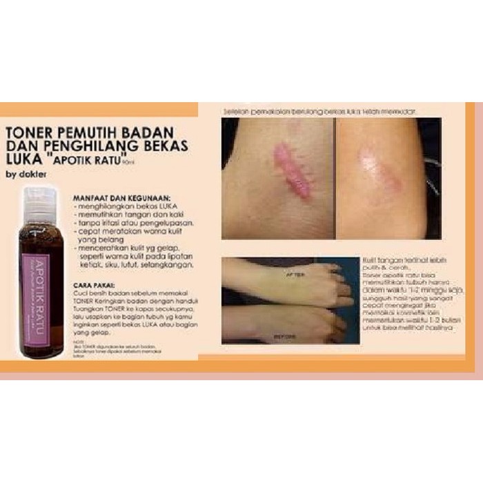 Cara Menghilangkan Bekas Luka Di Lutut Menghilangkan Masalah