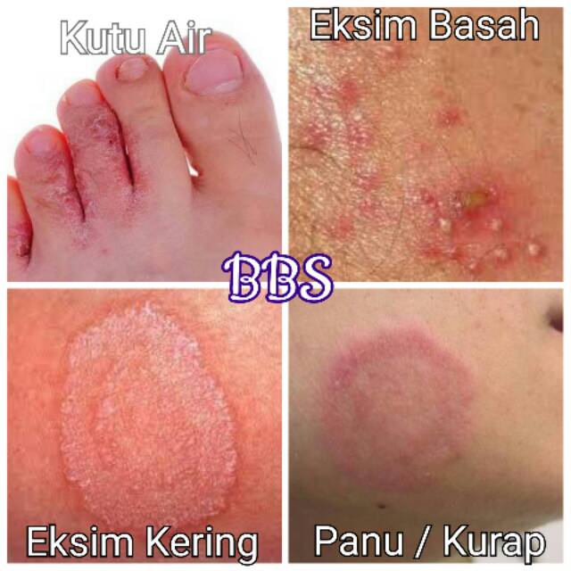 Obat Gatal BBS | Salep Gatal Eksim Kering Psoriasis Alergi | Shopee  Indonesia