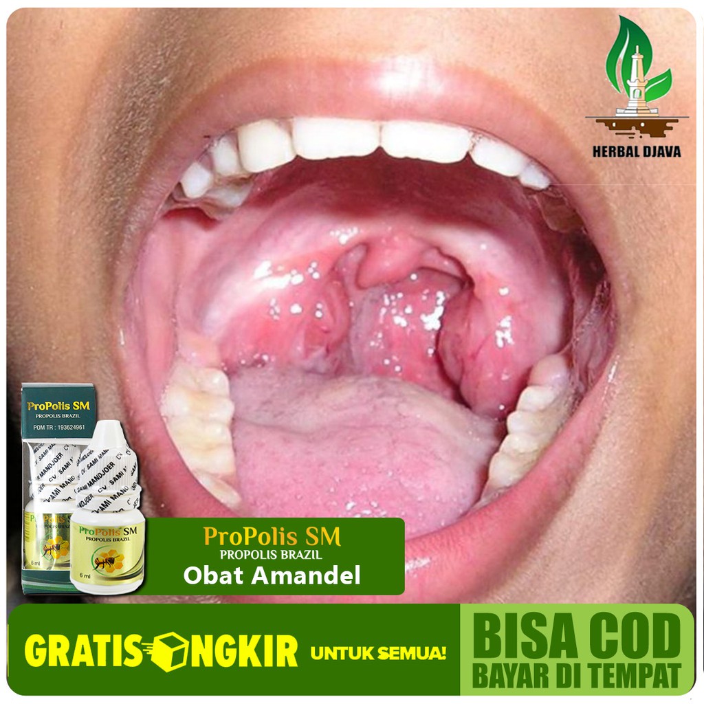 Jual Obat Amandel Tonsilitis Kronis - Radang Sakit Tenggorokan -  Sulit/Susah Menelan Herbal Propolis SM Indonesia|Shopee Indonesia