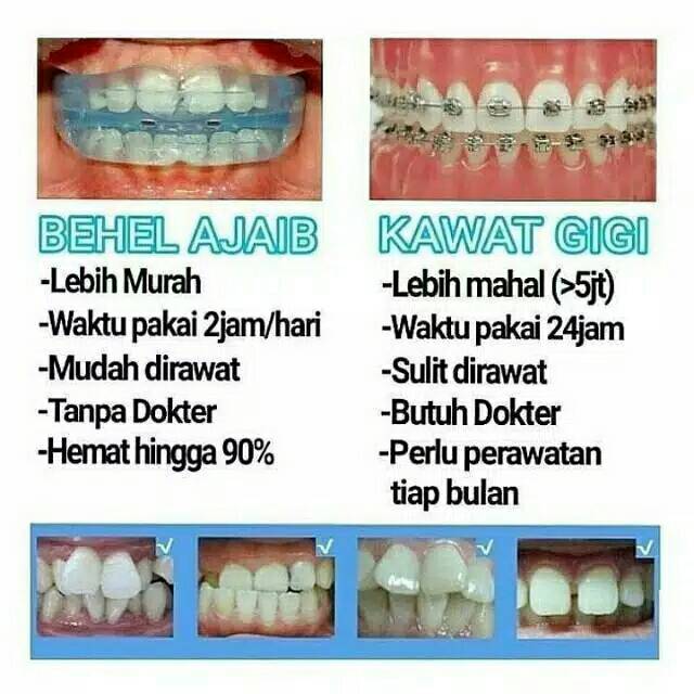 ORTHODENTIC RETAINER TEETH TRAINER ALIGNMENT BEHEL GIGI MERAPIKAN GIGI
