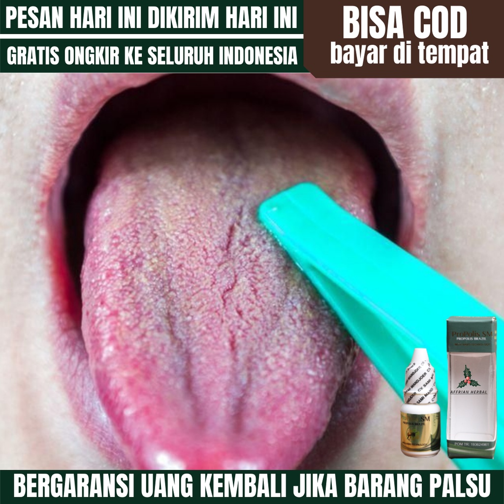 Jual Obat Tetes Lidah Putih, Obat Lidah Terasa Pahit, Obat Radang Lidah