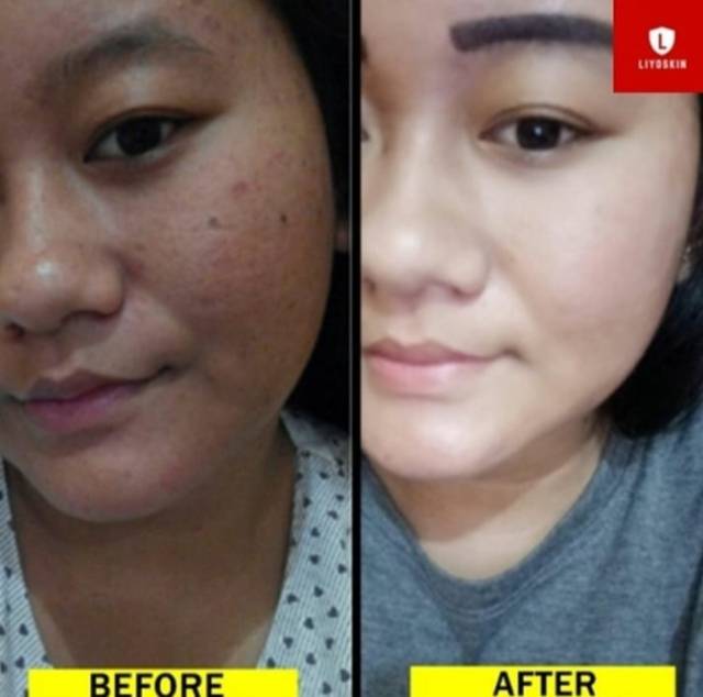 Jual Krim Penghilang Bintik Hitam Kecil Seperti Tahi Lalat Paling Cepat Dalam 10 Hari | Shopee Indonesia