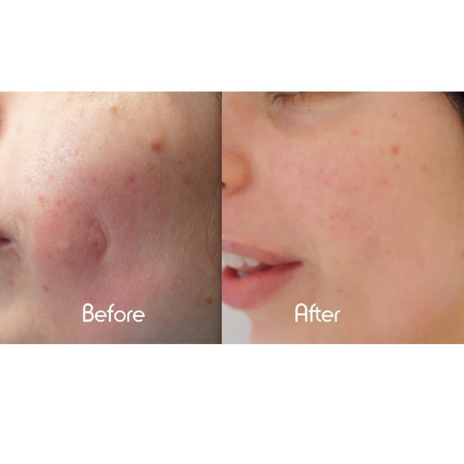 Mederma Advanced Scar Gel Before And After malayxexe