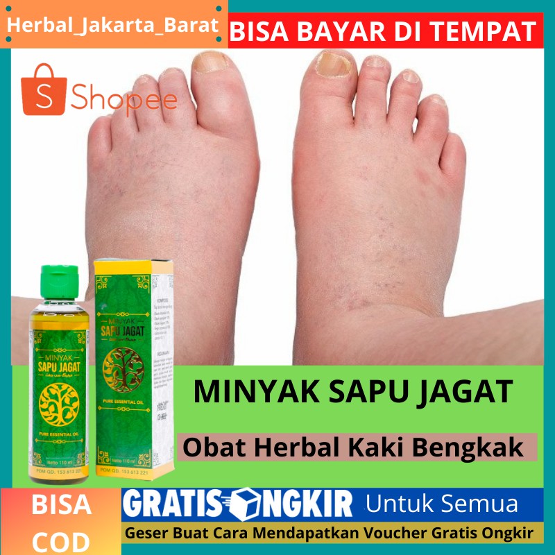 Obat Tradisional Untuk Bengkak Akibat Kesleo Jual Produk Obat Kaki
