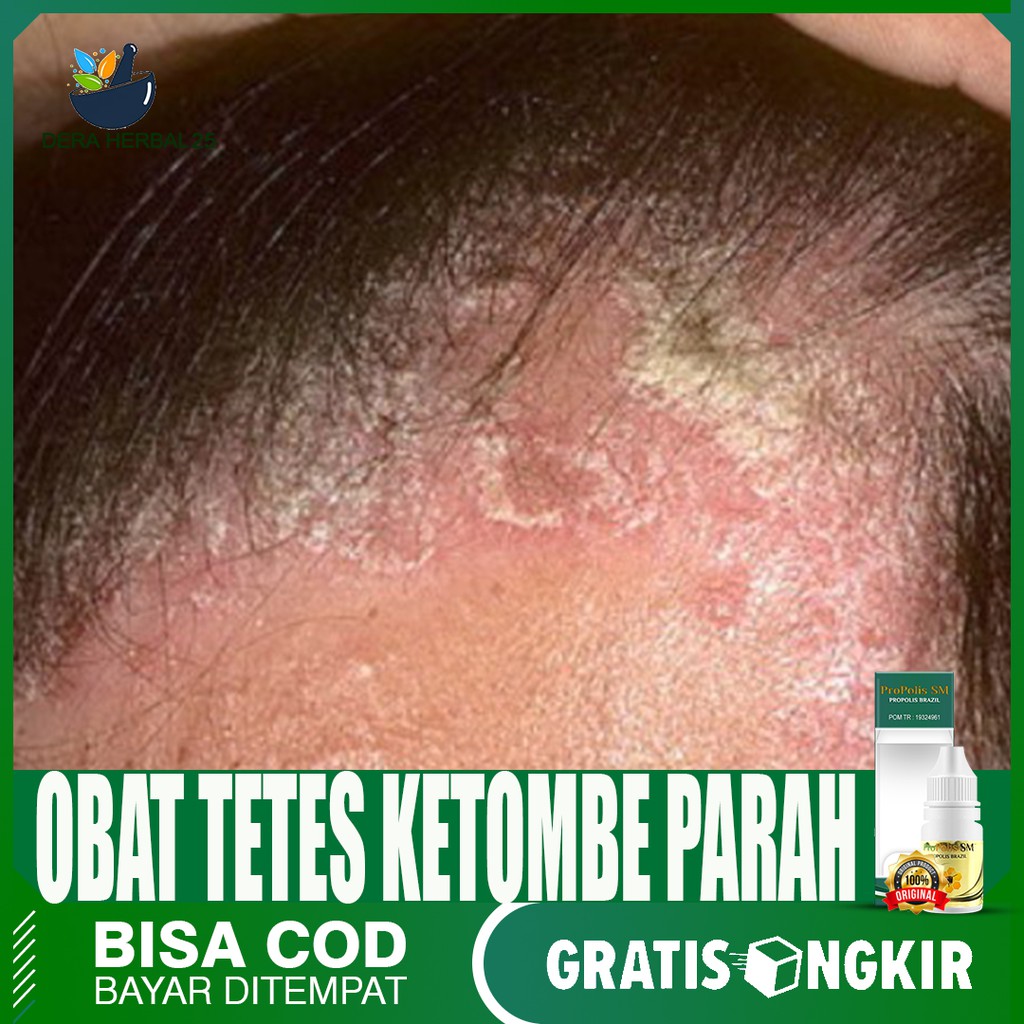 Obat Ketombe Basah Obat Ketombe Kering Obat Ketombe Berkerak Obat Ketombe  di T=Rambut Propolis Sm | Shopee Indonesia