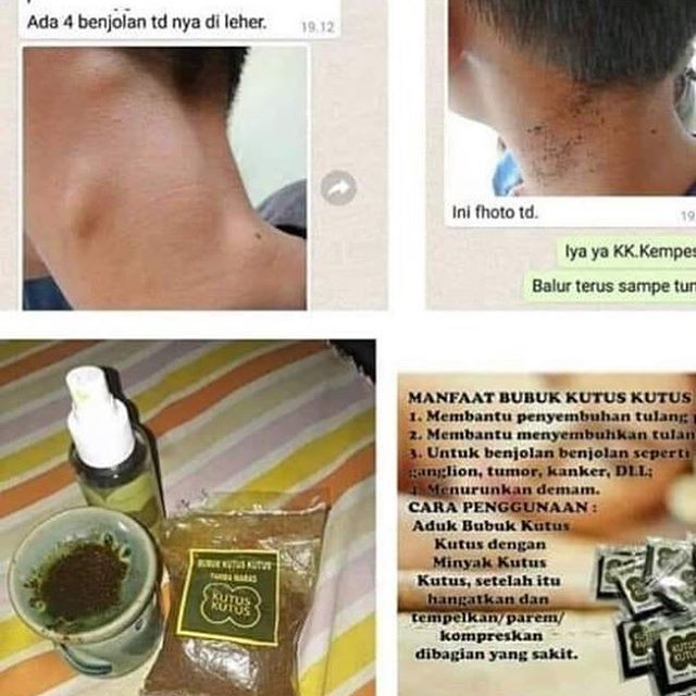 20+ Inspirasi Manfaat Minyak Kutus Kutus Untuk Benjolan Di Leher Sage