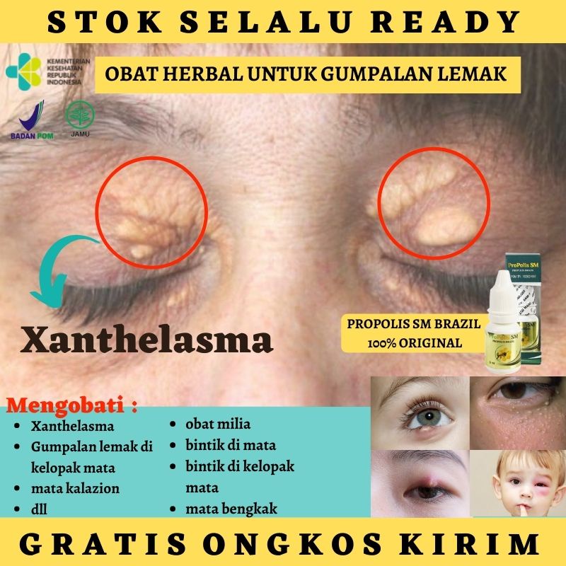 Jual JUAL Obat Penghilang Milia / Milia di Wajah / Milia di Kelopak Mata /  Obat Perontok Bintik Bintik Putih di Mata / di Kelopak Mata / Obat  Penghempas Gumpalan Lemak Yang
