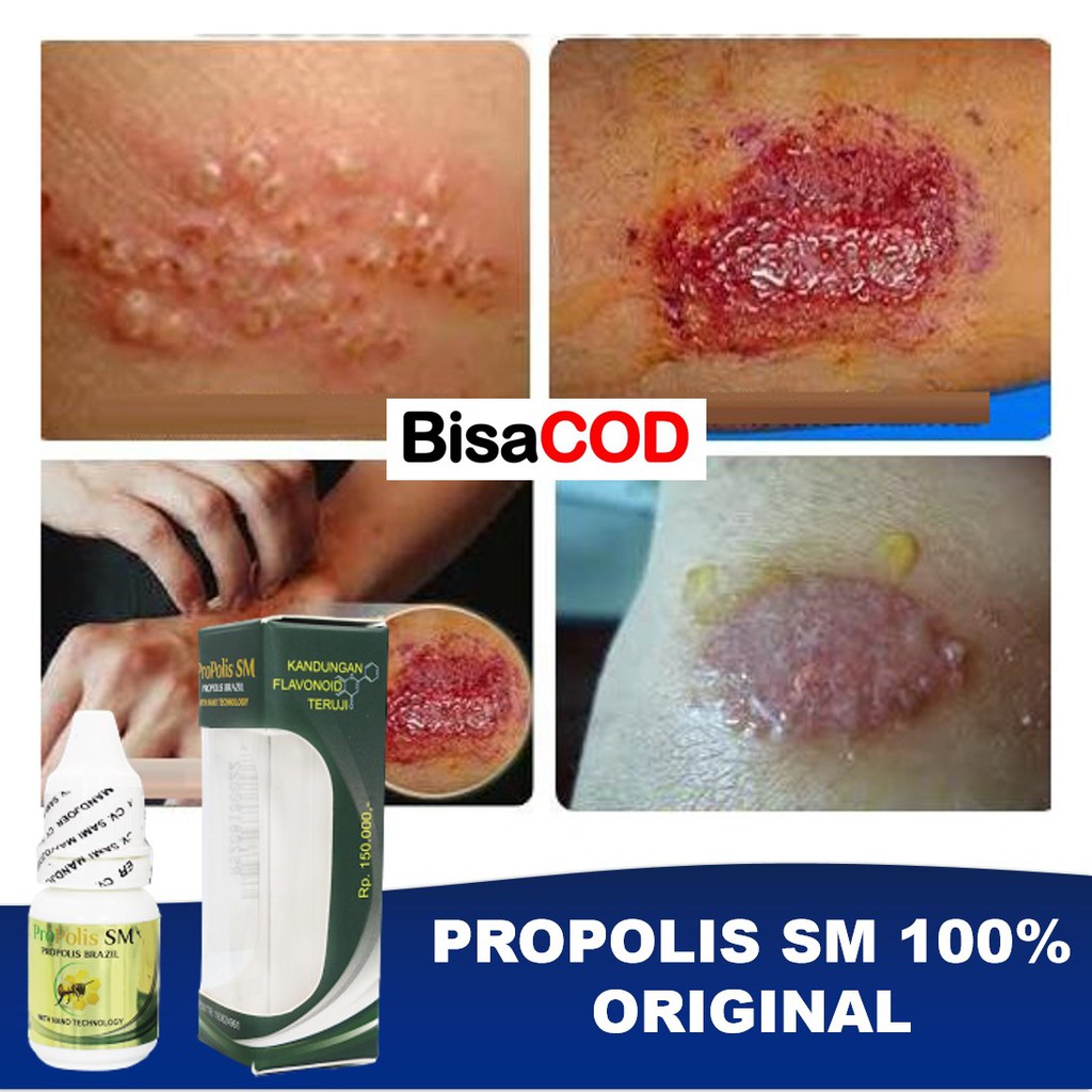 Propolis SM Obat Kurap-Gatal Gatal-Alergi-kulit Gatel-Kudis-Infeksi  Jamur-Cacar Air-Eksim-Kadas | Shopee Indonesia