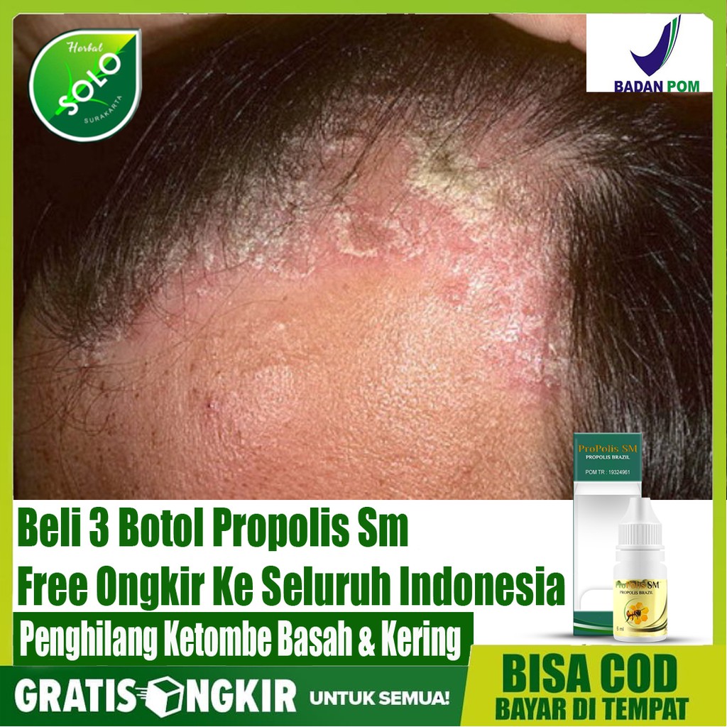 Obat Penghilang Ketombe Rambut, Ketombe Kering, Ketombe Basah, Gatal Ketombe  Di Kepala - Propolis Sm | Shopee Indonesia