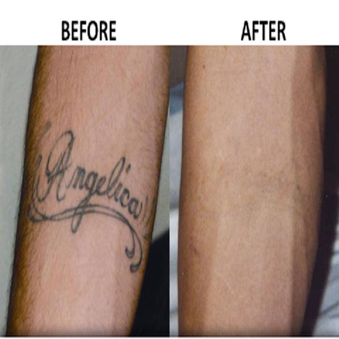 Tattoo Removal Indonesia Tatto Pictures