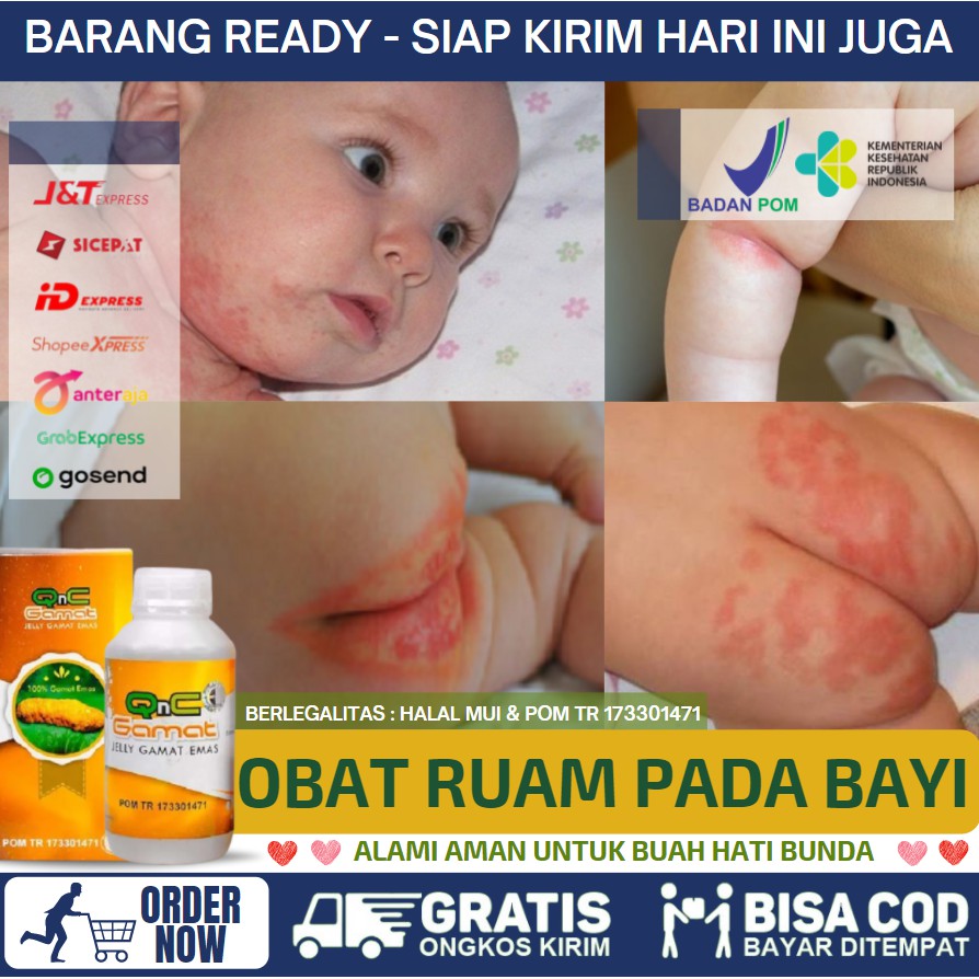 K24klik Biang Keringat Bayi Biang Keringat Atau Keringat Buntet Ini Disebabkan Karena Kulit Bayi Masih Dalam Tahap Pengembangan Dan Penyempurnaan Termasuk Kelenjar Keringatnya Terkadang Proses Penyerapan Dan Pengeluaran Keringat gatal pada leher bayi