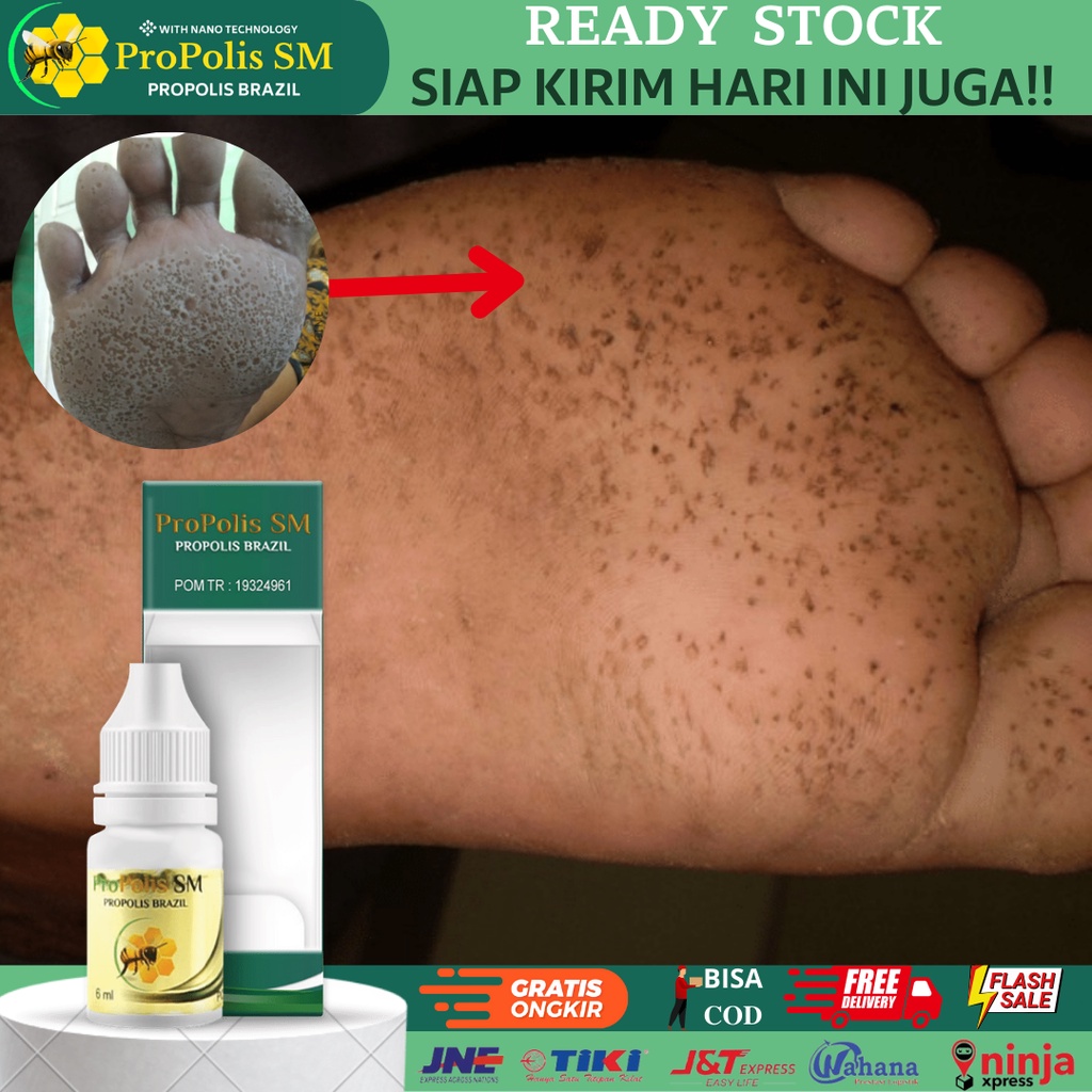Jual Obat Pitted Keratolisis/ Keratolysis, Obat Tumit Berlubang, Telapak Kaki Bolong Bolong