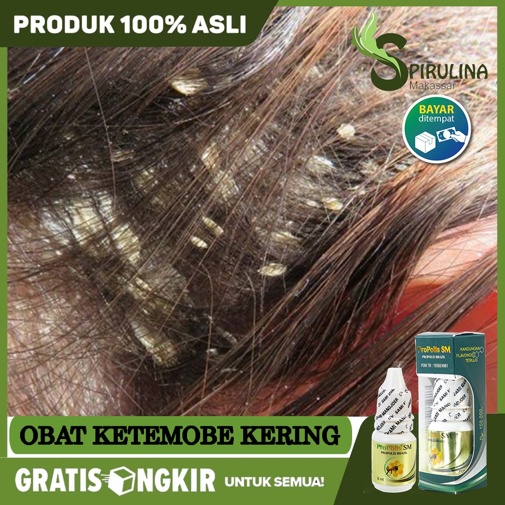 Obat Ketombe, Ketombe Menahun, Ketombe Basah, Ketombe Kering - Propolis Sm  di Makassar (COD) - Halal | Shopee Indonesia