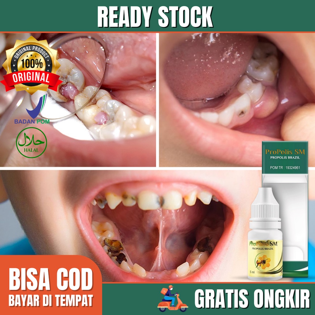Jual Obat Radang Gusi Bengkak Karena Gigi Berlubang, Gigi Ngilu Sakit. Obat  Sakit Gigi, Gigi Berlubang, Gusi Bengkak, Obat Gusi Bengkak Ngilu Sakit Gigi  Bernanah, Obat Sakit Gigi, Gusi Bengkak, Radang Tenggorokan -