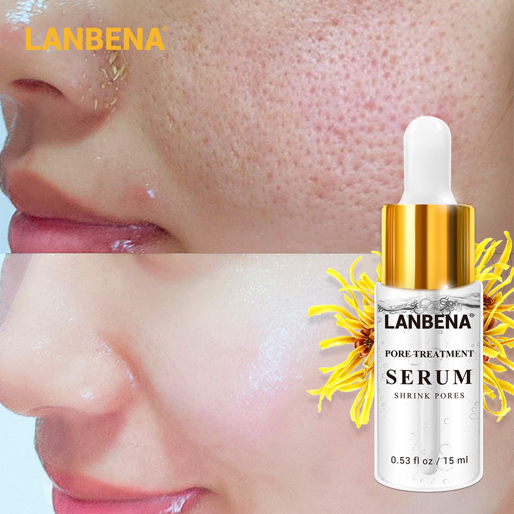 Acne Treatment Acne Vs Pimples