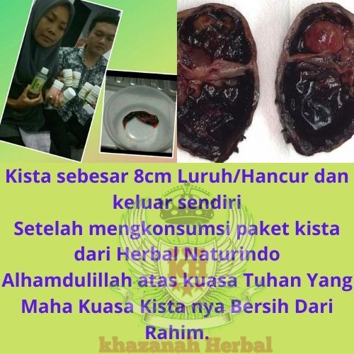 Jual Obat Herbal Kista Miom Cysto Up Spesial Mengobati Penyakit Kista Atau Miom Tanpa Operasi Naturindo | Shopee Indonesia