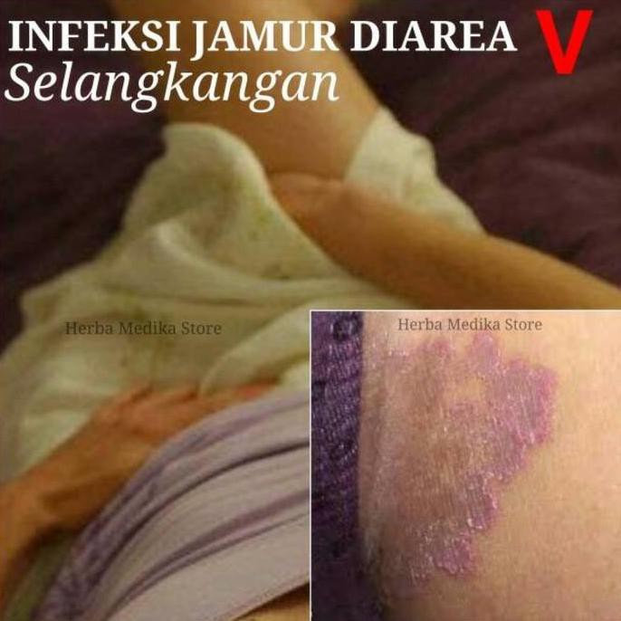 Cara Mengatasi Selangkangan Gatal Dan Hitam