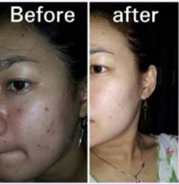 Jual Krim Penghilang Bintik Hitam Kecil Seperti Tahi Lalat Paling Cepat Dalam 10 Hari | Shopee Indonesia