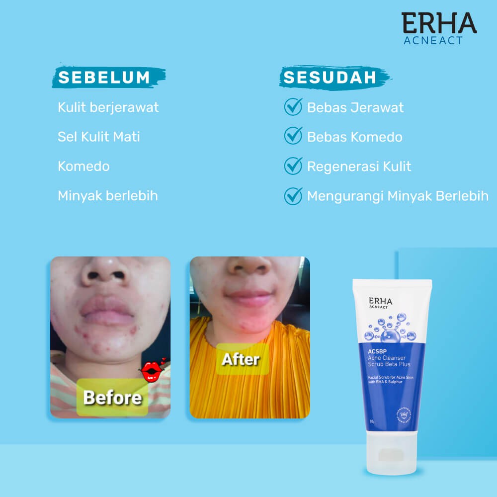 Erha Acne Duo Bundle (acne Treatment Package) KCzf 4erckkdp9y ThaiPick
