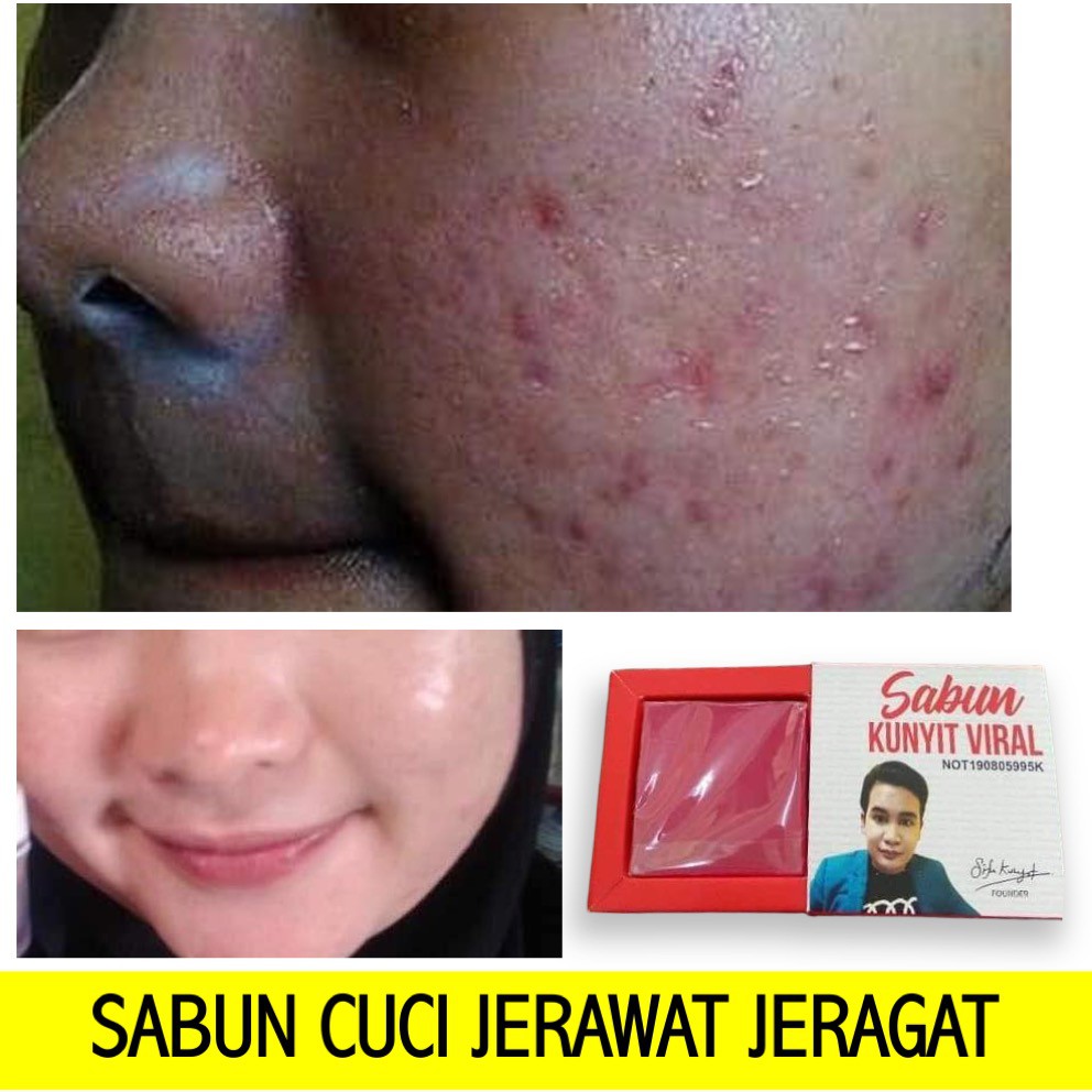 Cara Hilangkan Jeragat Dengan Kunyit Pupur Kunyit Cantikkan Wajah Sedangkan Pada Kunyit Senyawa Yang Ampuh Untuk Mengatasi Peradangan Adalah Kurkuminoid Inurlhtmlintitleindex77468s