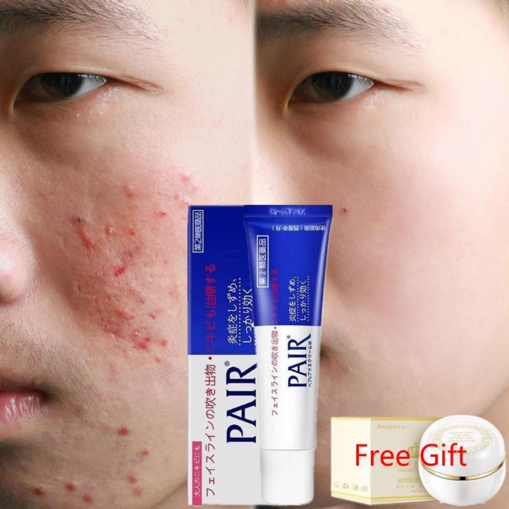 [LION PAIR] Japan Acne Treatment Cream Scar Removal Skin Care Powerful