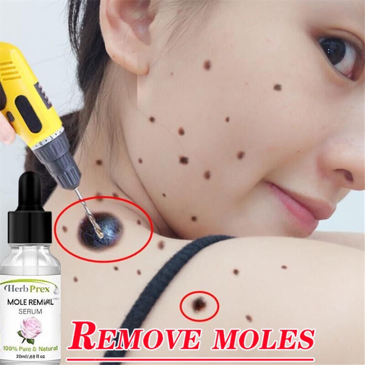 VE Facial mole remover freckles Essential oil Lightening Melanin Dark