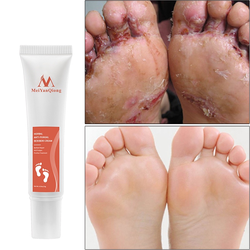 Foot Cream AntiFungal Infection Foot Relieve Foot Itching Cream