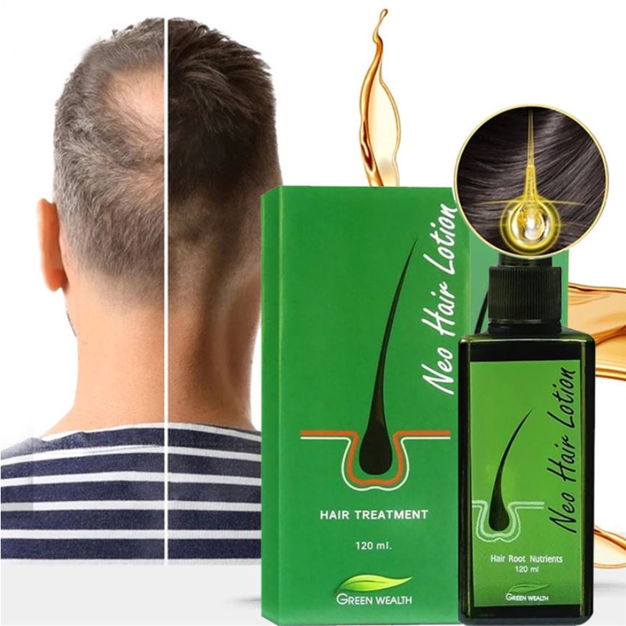 Neo Hair Lotion Hair Loss Treatment 30ml Shopee Malaysia