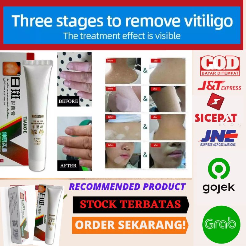 Salep VITILIGO Skin Ointment TIANGE Eliminate White Face Spots Striped