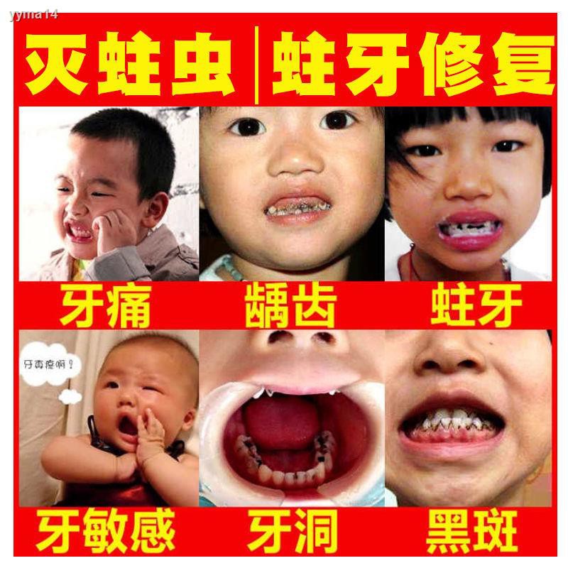 Tooth decay repair, cavities, worms, black spots, children’s tooth