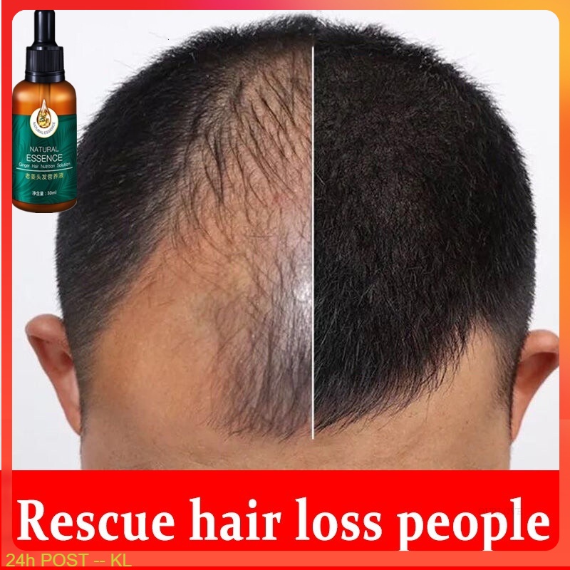NEO HAIR LOTION ORIGNAL100 free gift Hair Transplant and Hair Loss