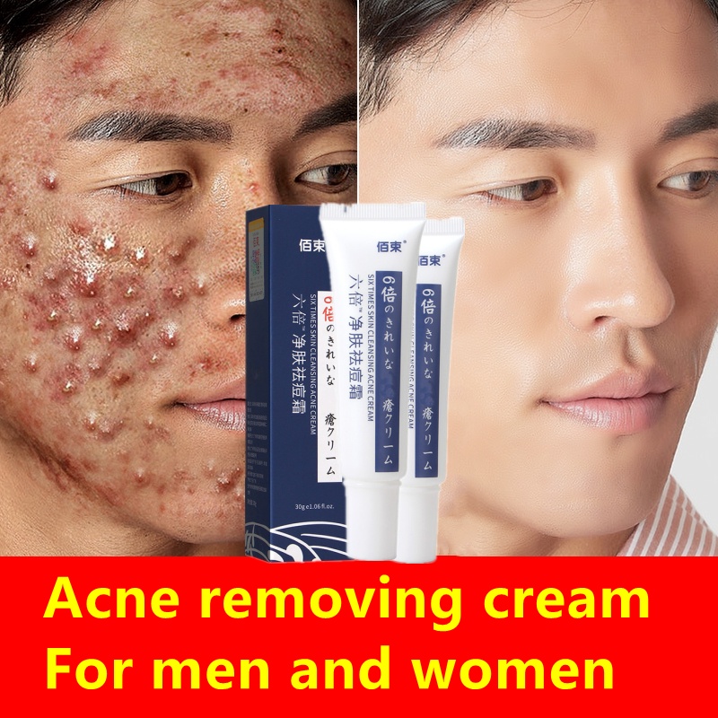 Repair acne removing cream anti pimples acne marks acne pits fade