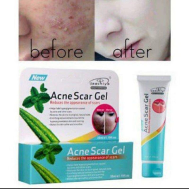 Aloe Vera Acne Scar Gel, Acne Scar Treatment, Acne Pimple Spot Scar