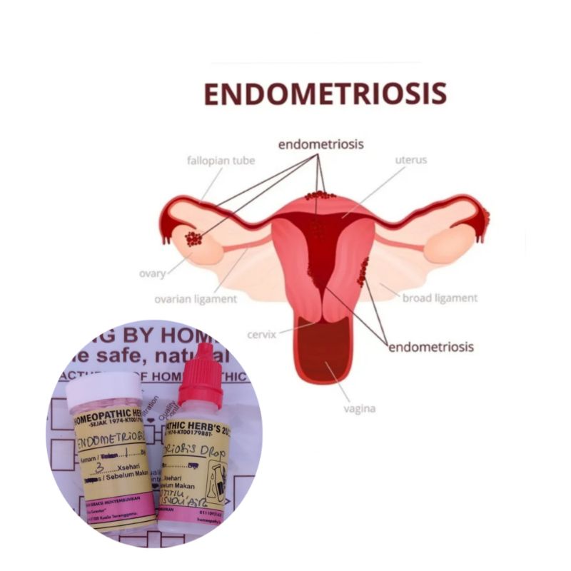 ENDOMETRIOSIS by Homeopathy Shopee Malaysia