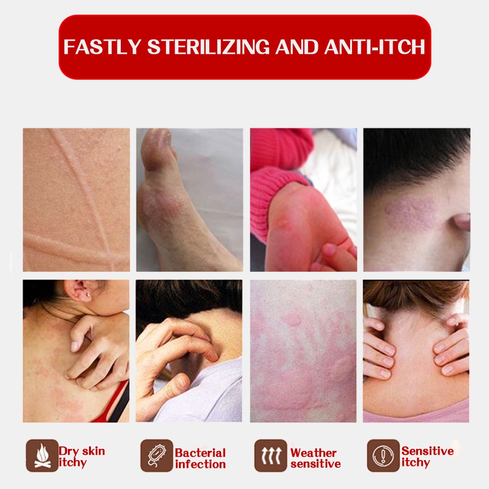 18g Ointment Herbal Treatment Skin Itching Antibacterial Tinea Pedis