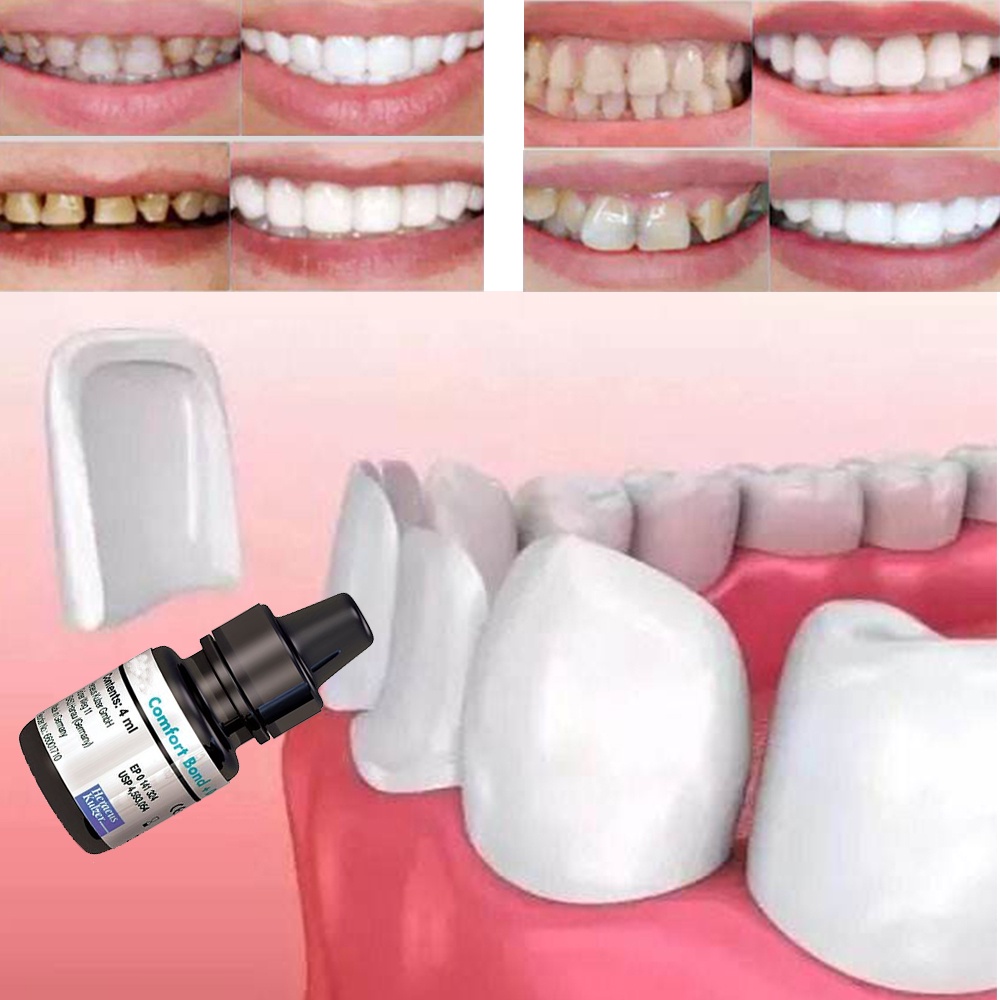 Teeth Veneers Paste Gel Quick Adhesive Dental Comfort Bond Desensitizer