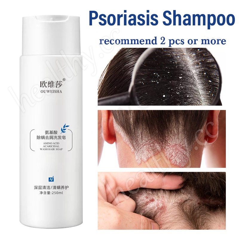 250ML Psoriasis Shampoo Anti dandruff Amino acid shampoo Removes mites