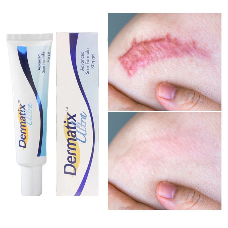 Dermatix Effective Scar Removal Cream Scar Gel Old Scars Acne Scars