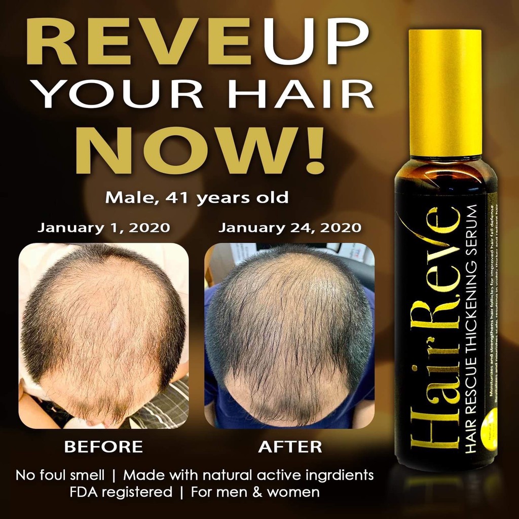 Hair Loss 2023