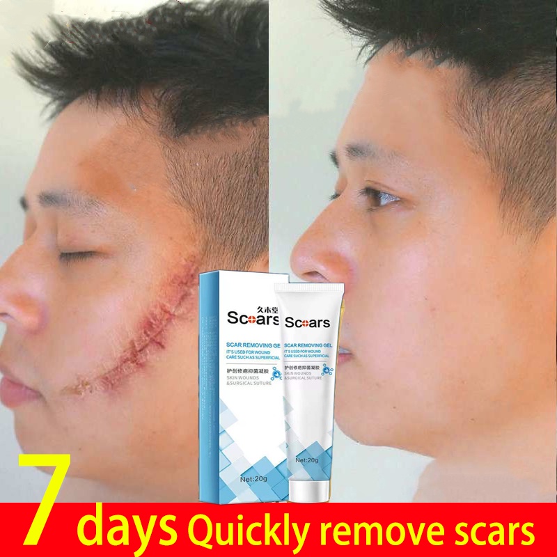 20g Scar Cream Effective Scar Repairing Gel light fades acne scars stretch marks repair cream