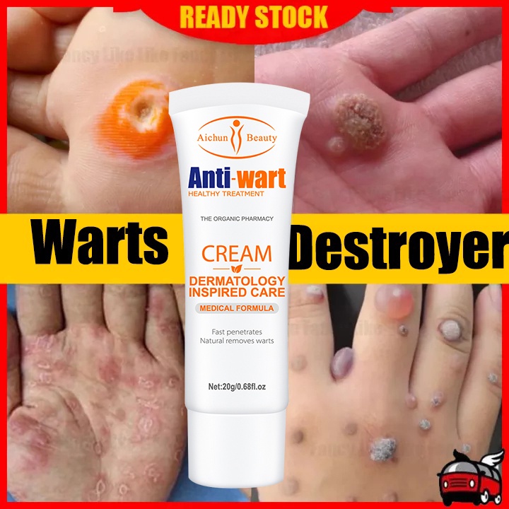 Warts Remover Cream original wartz removal cream Growth Warts Remover
