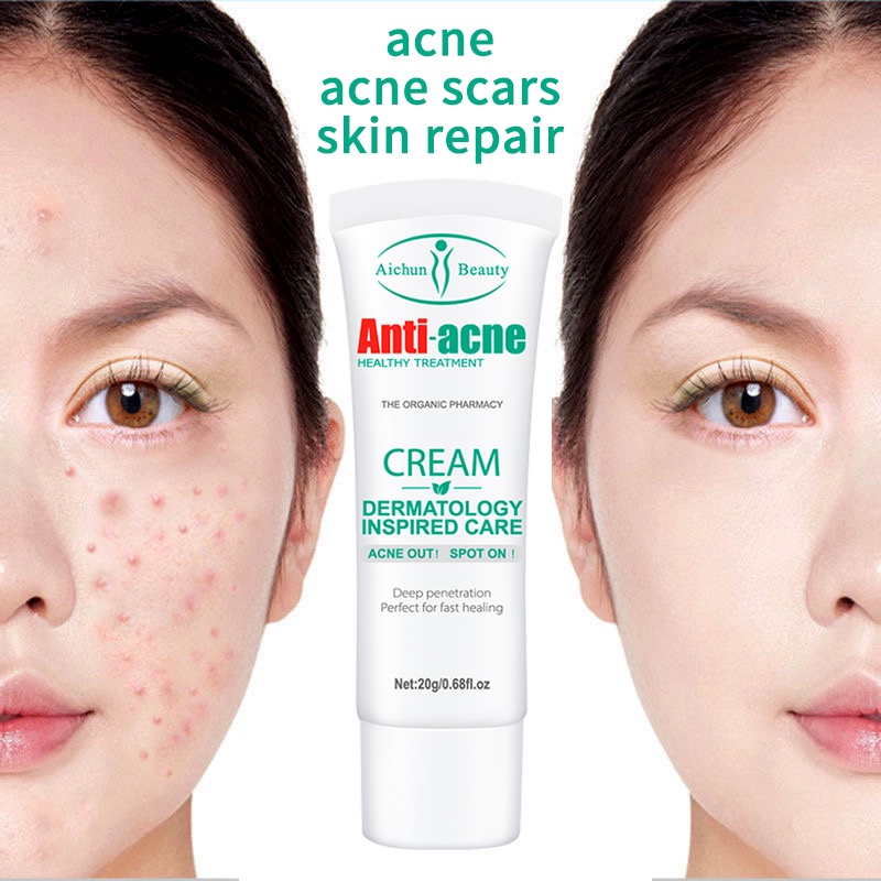 Acne remover pimple remover anti acne cream 20g pimples remover acne
