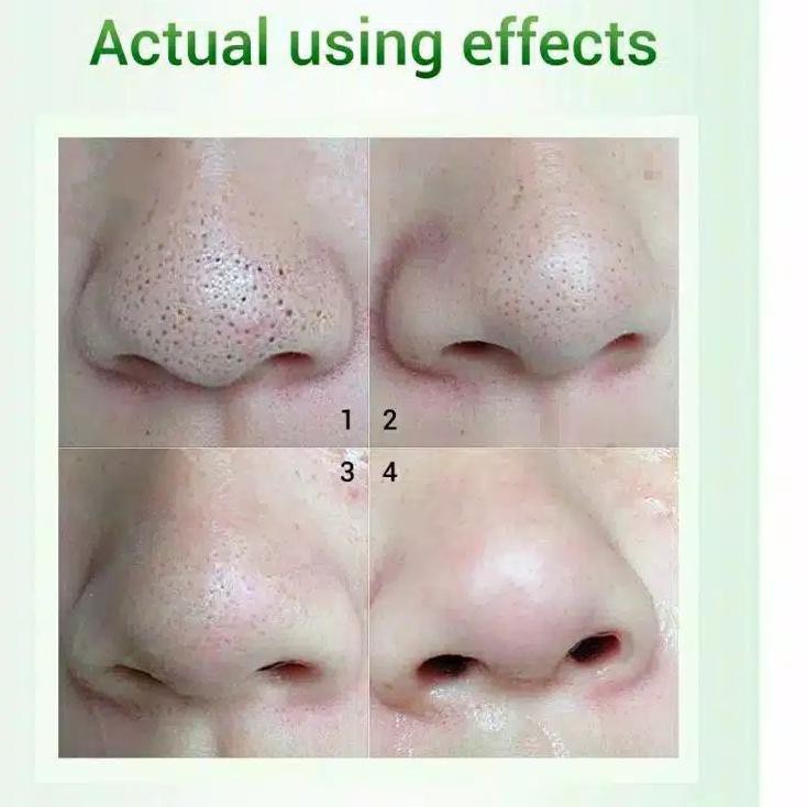 blackheads extraction 2023 Wholesale Breylee Blackhead Mask - Brylee Blackheads And Shrink Pores | Shopee Philippines