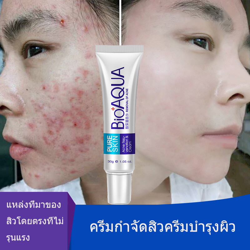 Do not let acne affect your beauty, acne treatment cream, raw materials