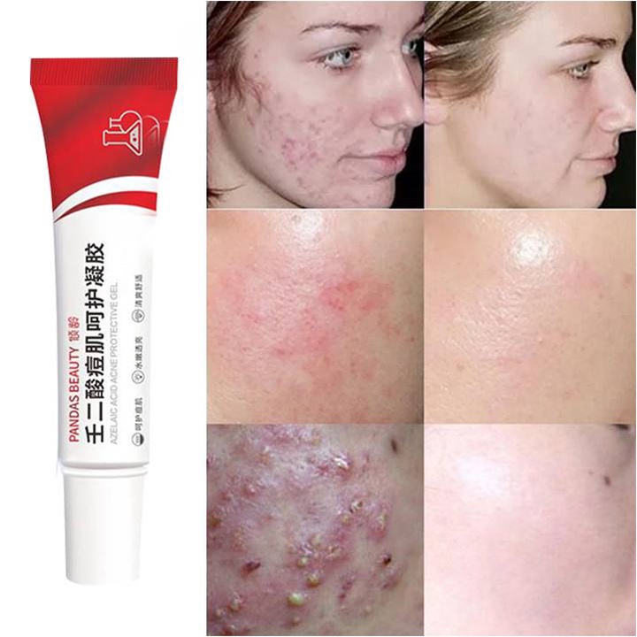 Azelaic Acid Acne Repairing Gel Azelaic Acid Gel Acne Cream Acne Sign